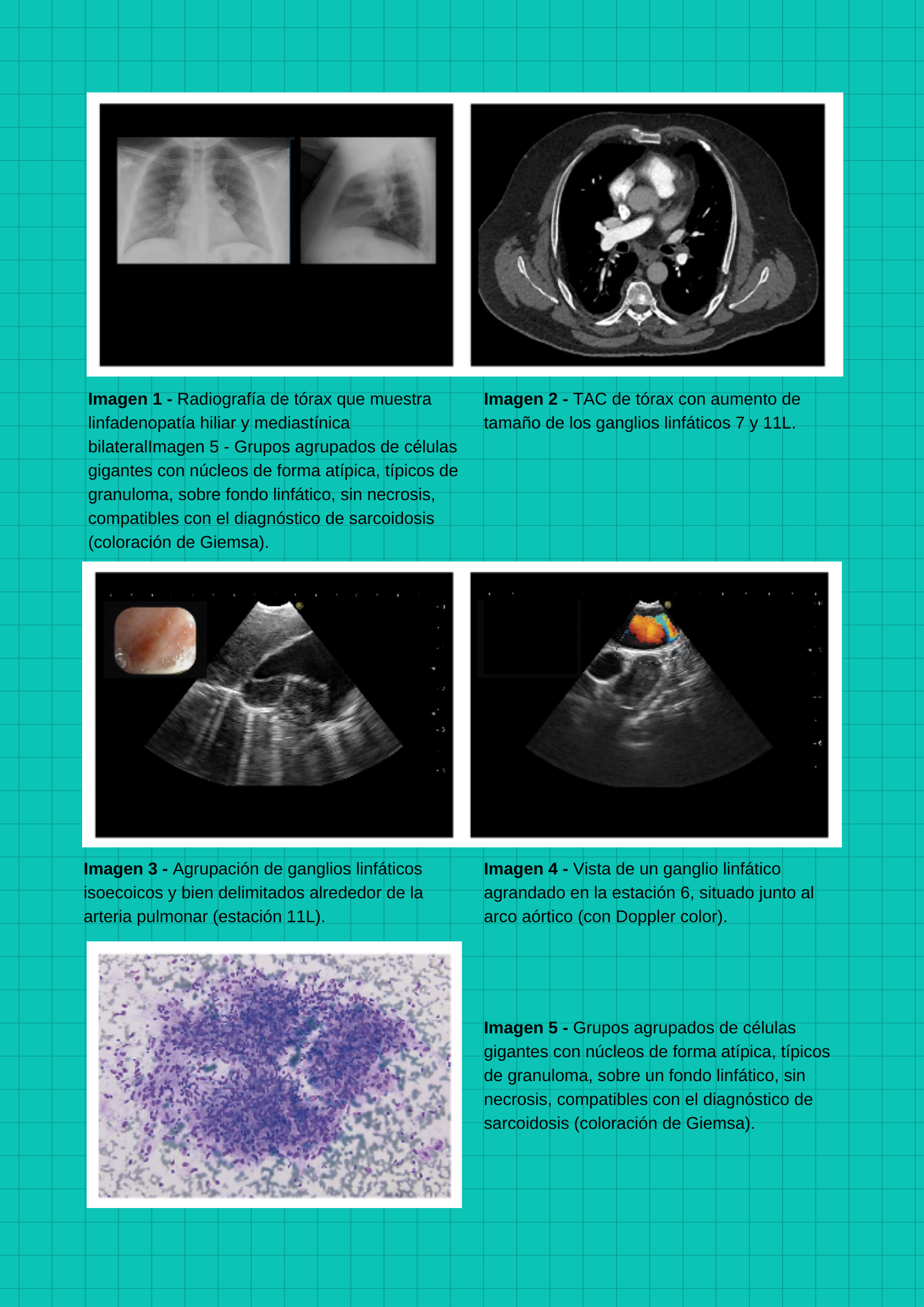 diversas imágenes de detección de Sarcoidosis 