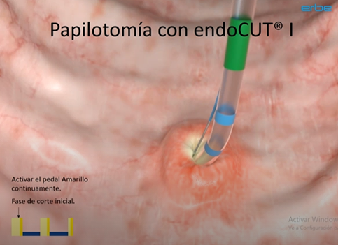 Papilotomía con EndoCut I