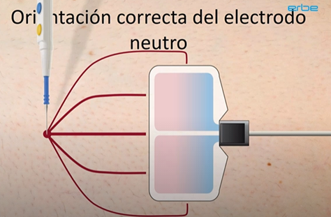 colocación del electrodo neutro 2