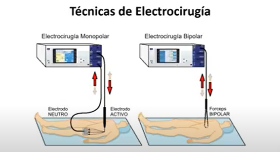Técnicas de electrocirugía